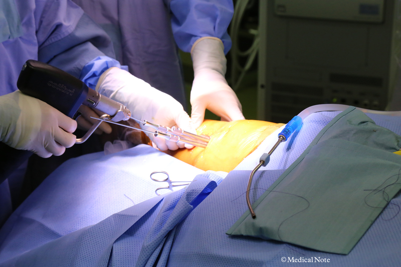 骨軟骨柱移植術（モザイクプラスティー）の追加