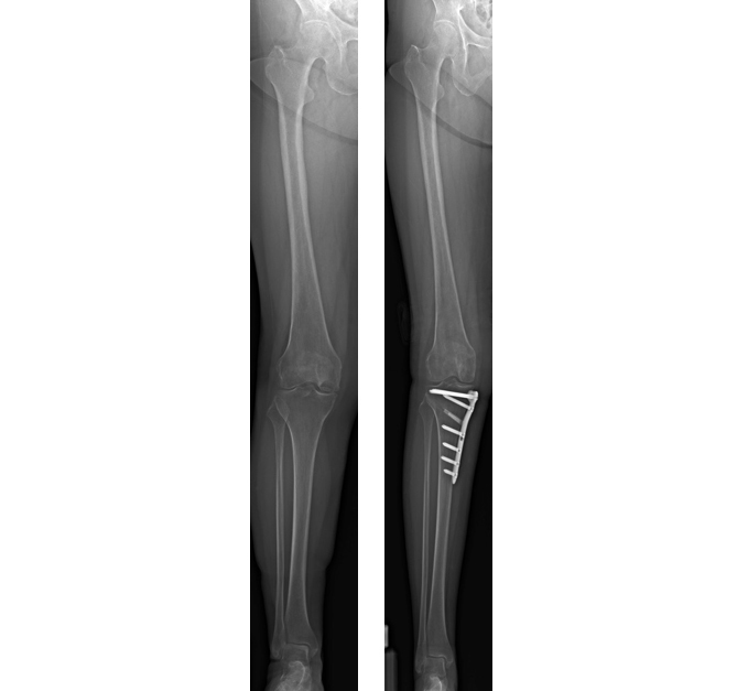 膝周囲骨切り術（AKO）で健康な膝を！ 治療の見直しも検討してほしい