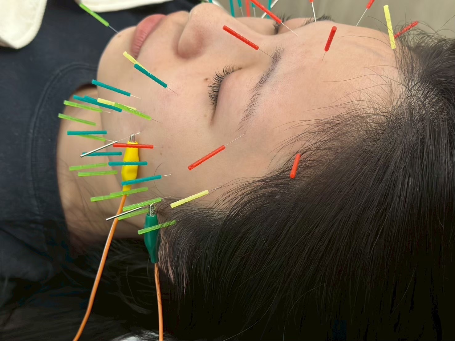 鬼ルート美容鍼or美骨・美容鍼  30分コース