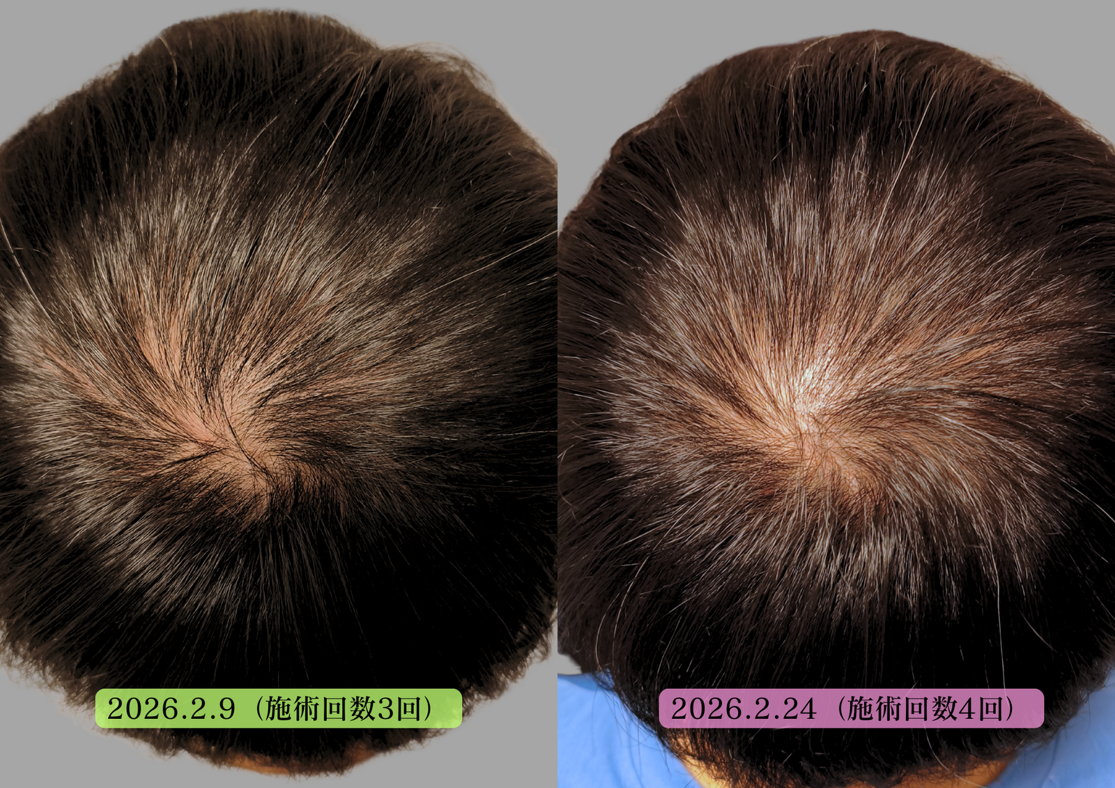 初回体験【抜け毛・分け目・頭皮が透ける方に】育毛鍼+LED+ヒト幹細胞