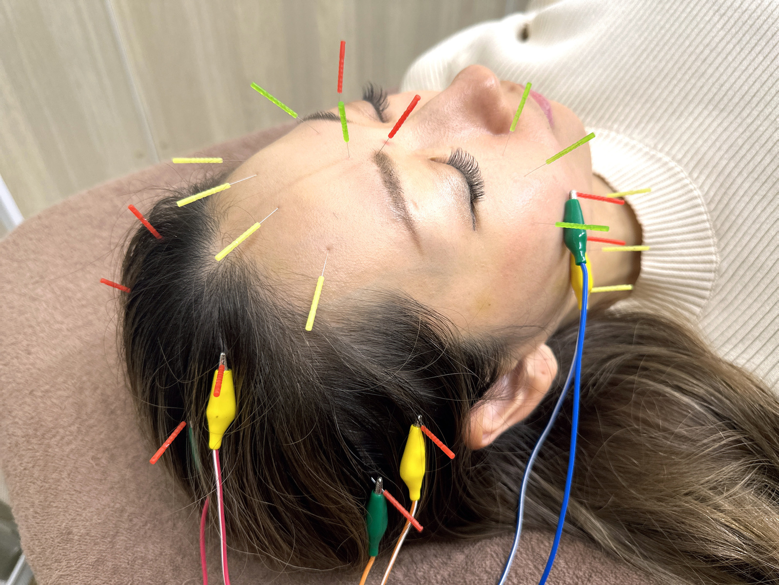 【初回限定】鬼ルート美容鍼or美骨・美容鍼