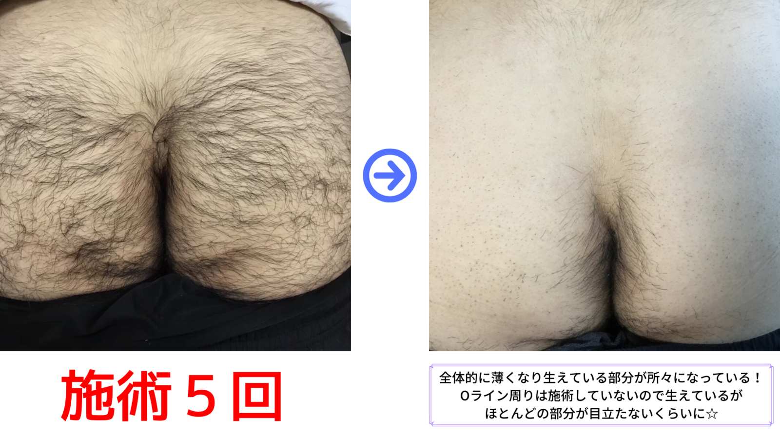 お尻脱毛