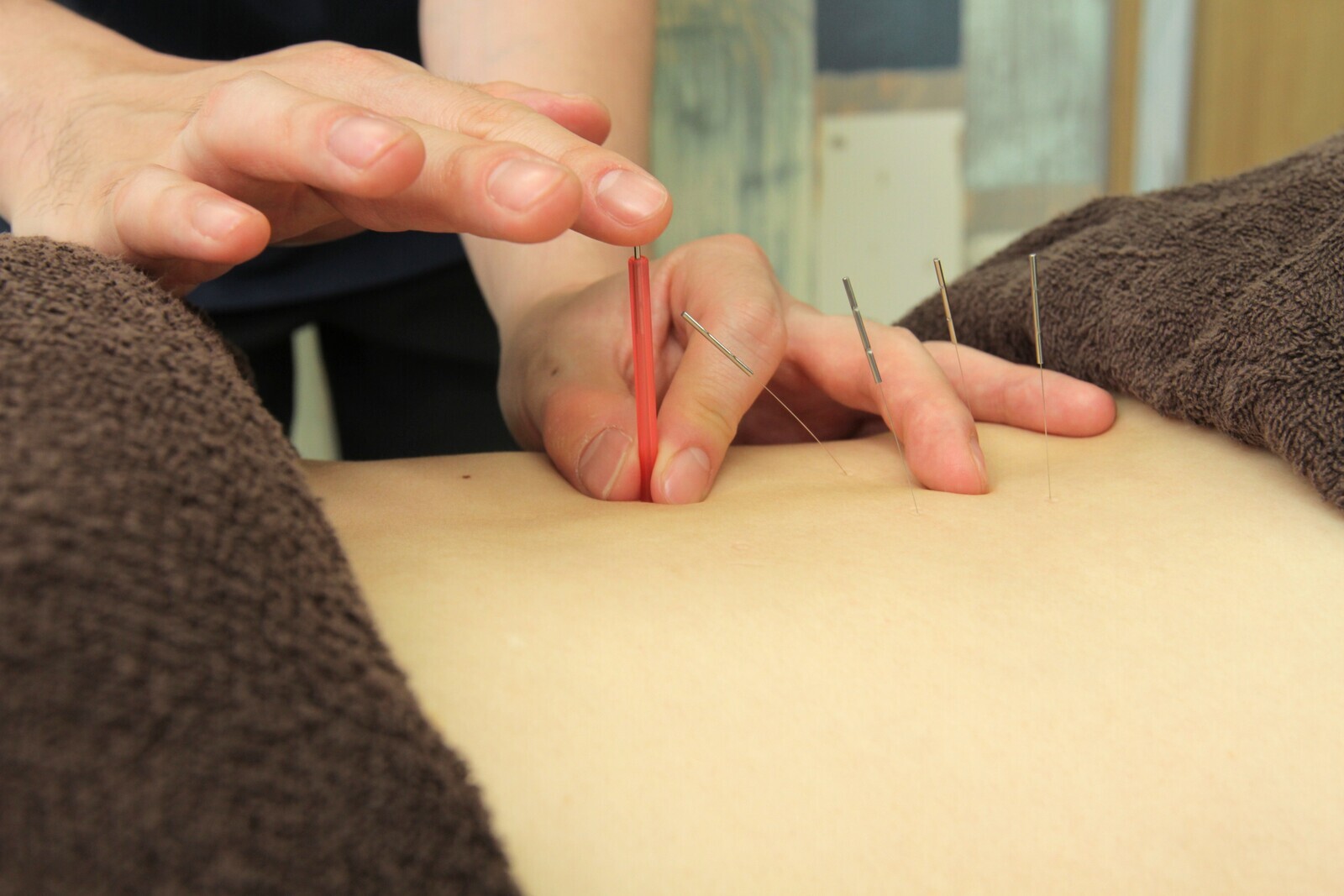 鍼灸施術（2回目以降）