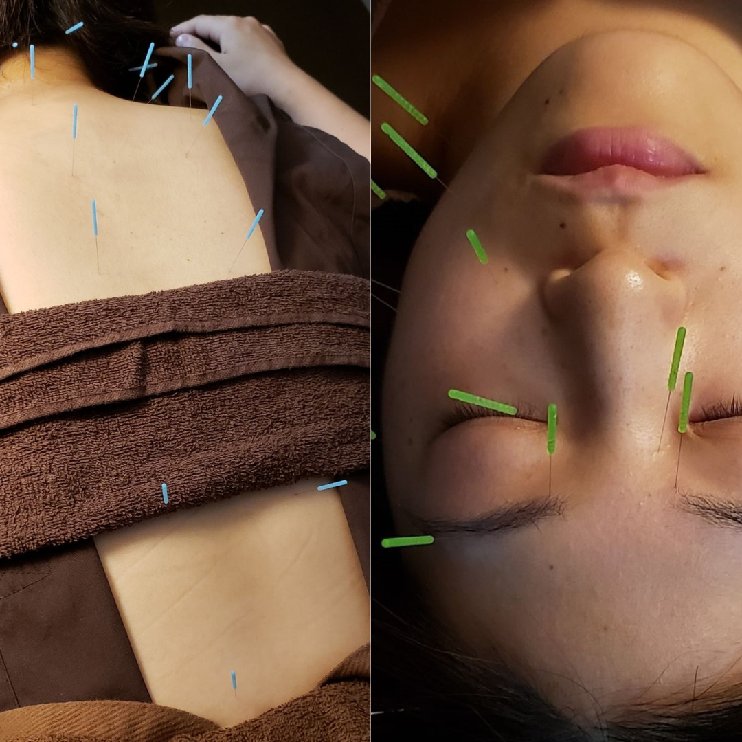 【顔も身体も癒しを】全身鍼+美容鍼(90分)