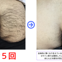 ★尻脱毛
