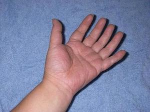 指が6本 多指症 の原因は 遺伝確率や合併症 手術後画像や有名人まで 女性のライフスタイルに関する情報メディア