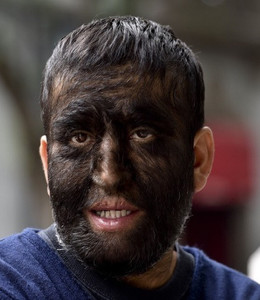 多毛症ってなに 男性の症状画像が 女性はピルで軽減できる 女性のライフスタイルに関する情報メディア 多毛症ってなに 男性の症状画像が 女性はピルで軽減できる 女性のライフスタイルに関する情報メディア