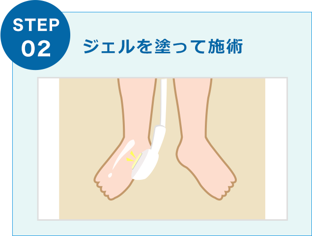ジェルを塗って施術