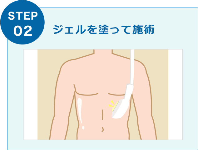 ジェルを塗って施術
