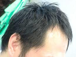 若ハゲ 薄毛画像 写真まとめ ハゲの基準はどこから 頭頂部 つむじ 側頭部 ハゲケン