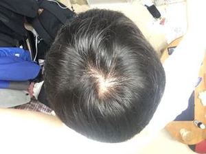 若ハゲ 薄毛画像 写真まとめ ハゲの基準はどこから 頭頂部 つむじ 側頭部 ハゲケン