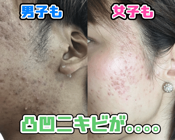 肌がキレイな男は好印象 ニキビ跡でボコボコだった彼が試した方法