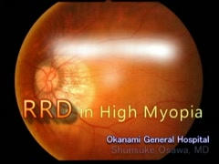 Surgical Strategy of RRD in High Myopia