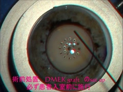 角膜浮腫が高度なLI後水疱性角膜症に対するDMEK