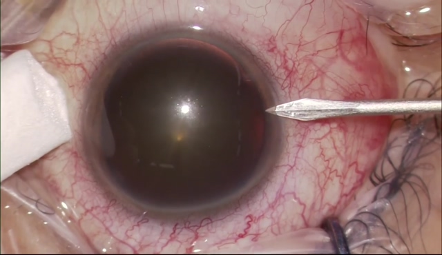 GSLトリプル (Ocular Mori Upright Surgical Gonio Lens) No.1