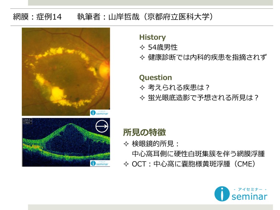 網膜：症例14