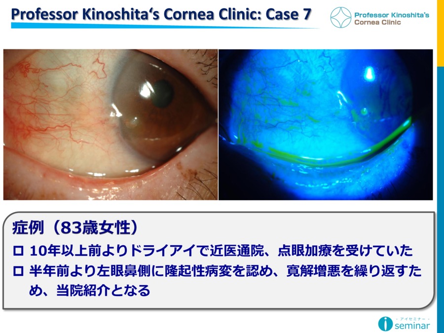 Professor Kinoshita‘s Cornea Clinic ： Case7