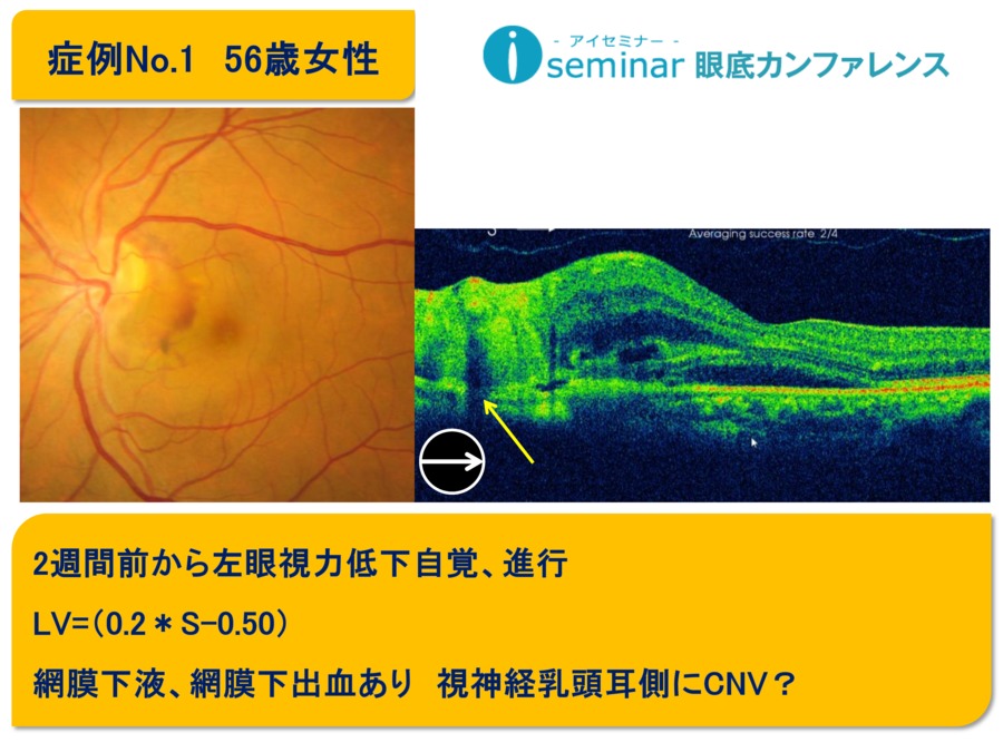 iseminar眼底カンファレンス：Case1