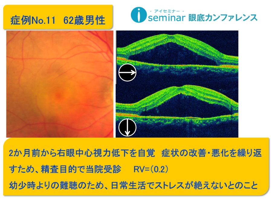 iseminar眼底カンファレンス：Case11