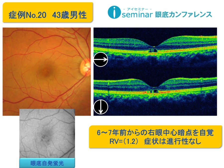 iseminar眼底カンファレンス：Case20