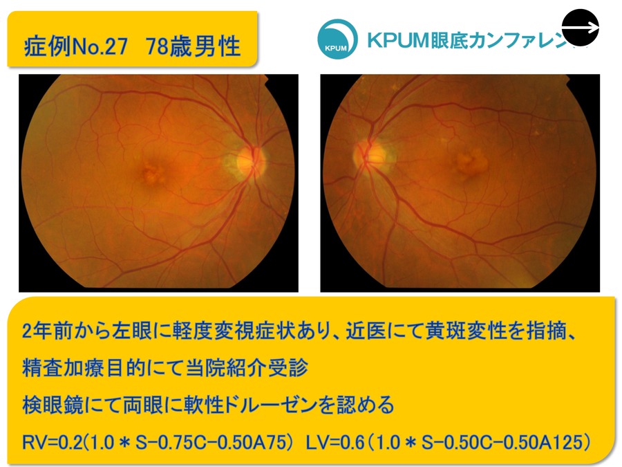 iseminar眼底カンファレンス：Case27