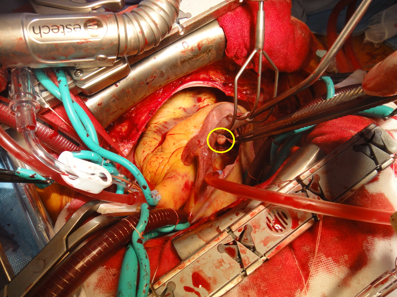 黄色の丸で示している白く丸い塊が疣贅