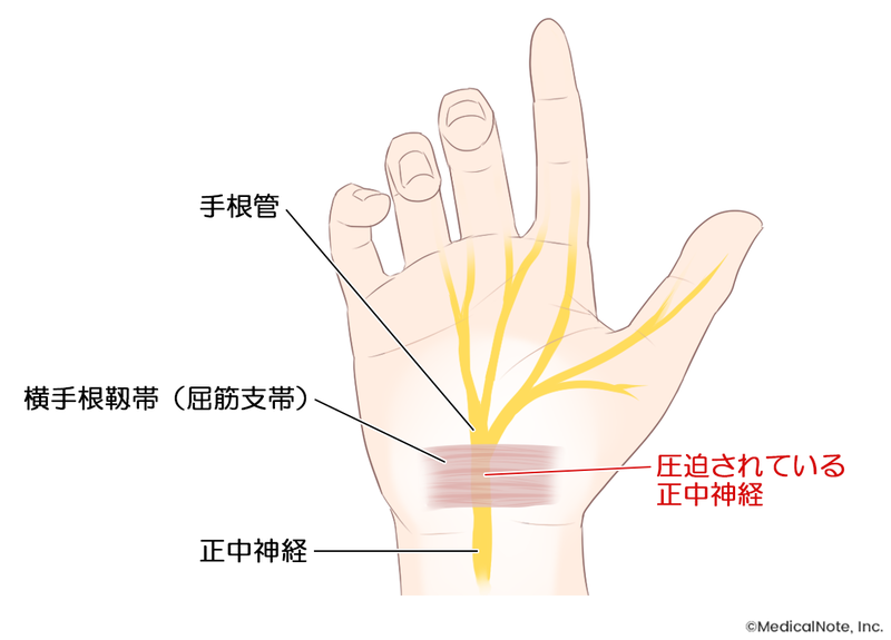 手根管症候群の手術