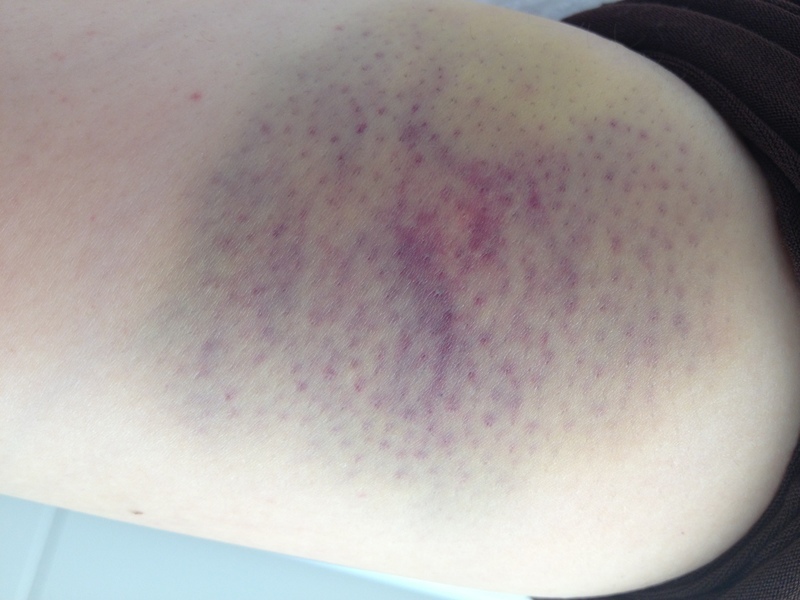 ITP（特発性血小板減少性紫斑病）患者さんのあざの写真