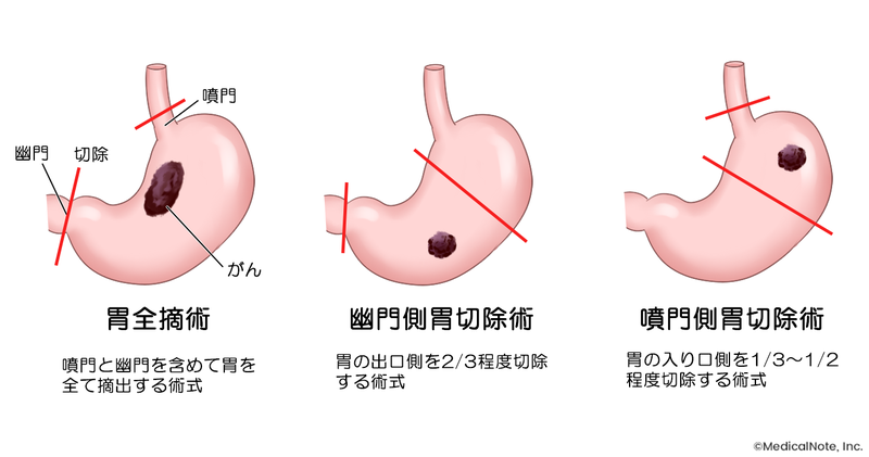 胃がん手術の種類