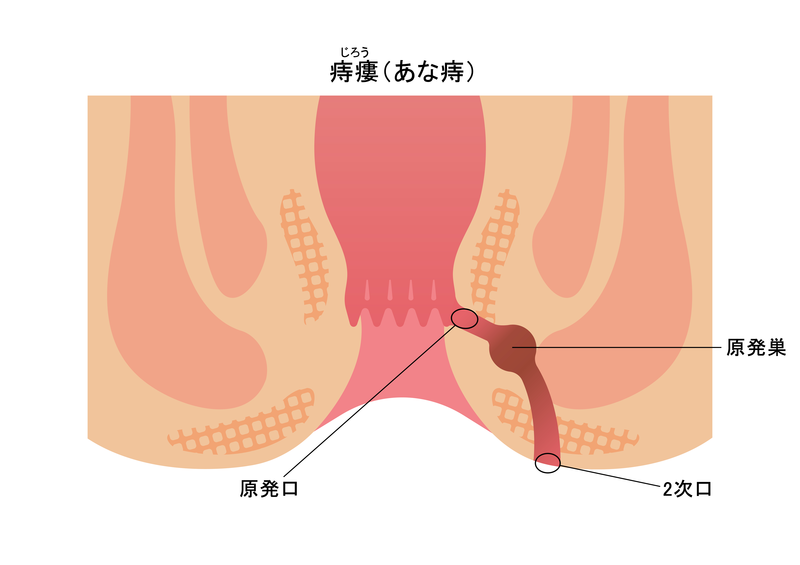 痔瘻