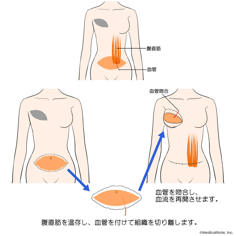 自家組織再建