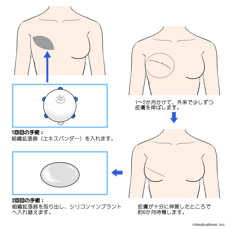 人工物再建