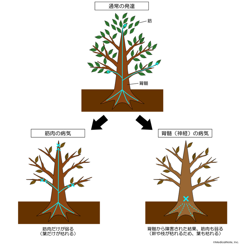 筋肉と脊髄、それぞれが原因の場合の違いのイメージ図