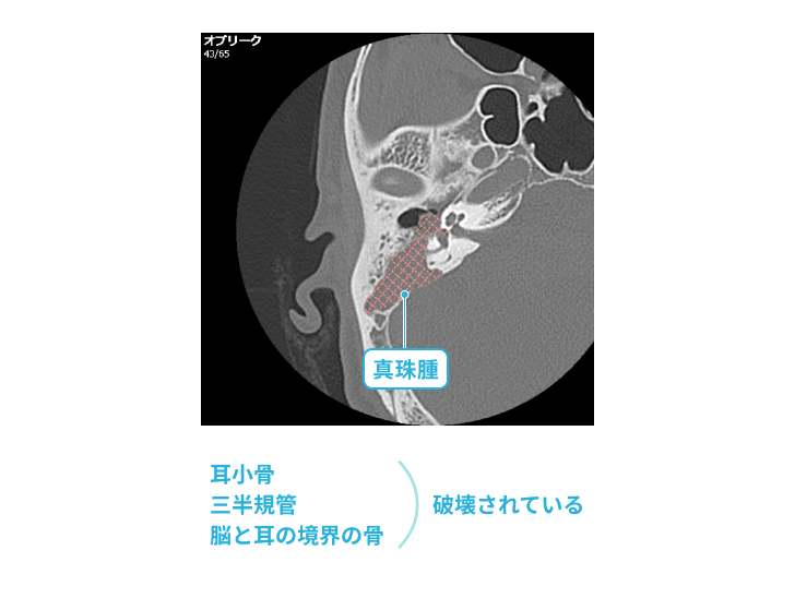 真珠腫による骨の破壊が起きているCT画像