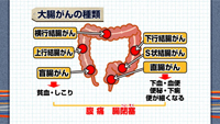 「見つかりにくい」大腸がん特集…こんな症状には注意 : yomiDr. / ヨミドクター（読売新聞）