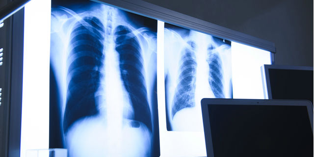 高齢者に多い誤嚥性肺炎…発症前に覚えておくべき予防対策リスト Doctors Me(ドクターズミー)