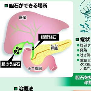 何度も繰り返す胆石症…野菜、果物とって予防 : yomiDr. / ヨミドクター（読売新聞）