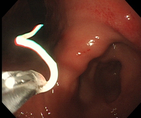 アニサキス治療の第一選択は内視鏡での摘出 醤油、お酢では死滅しません (デイリースポーツ) - Yahoo!ニュース