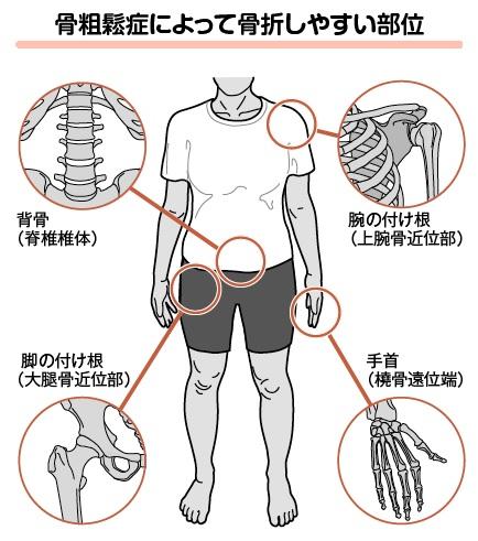 「いつのまにか骨折」引き起こす骨粗鬆症　若い女性も要注意 (1/3) 〈dot.〉｜AERA dot. (アエラドット)