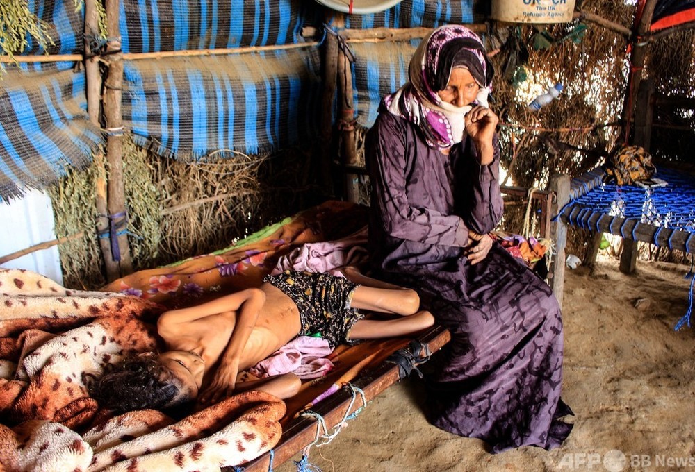 イエメン、5歳未満40万人が栄養失調で死亡の恐れ 国連 写真1枚 国際ニュース:AFPBB News