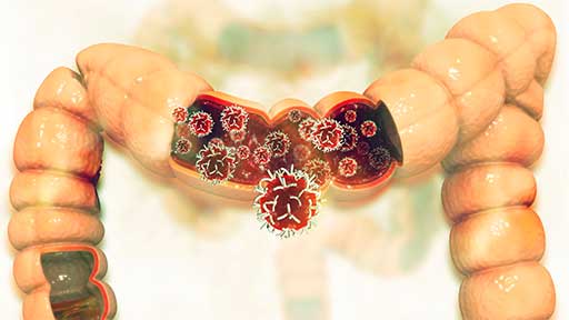 ステージ４大腸がん　無症状なら「手術せず抗がん剤」が標準治療に　ＪＣＯＧ : yomiDr./ヨミドクター（読売新聞）