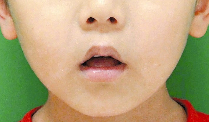 「お口ぽかん」全国調査で子どもの３割、想定外の結果に…成長期には難しい自然治癒 : 医療・健康 : 読売新聞オンライン