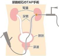 突然やってくる尿路結石 予防には食生活改善が大切(山陽新聞デジタル) - Yahoo!ニュース