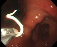 アニサキス治療の第一選択は内視鏡での摘出 醤油、お酢では死滅しません (デイリースポーツ) - Yahoo!ニュース