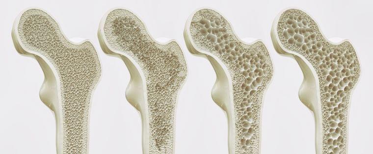 ②骨粗しょう症 | 骨強度の低下を特徴とし骨折のリスクを増大しやすくなる疾患への対策