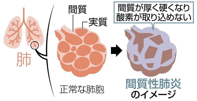 間質性肺炎 高齢化で増 息切れ、せき 見逃さずに 予後悪く 原因別で多様な種類:東京新聞 TOKYO Web