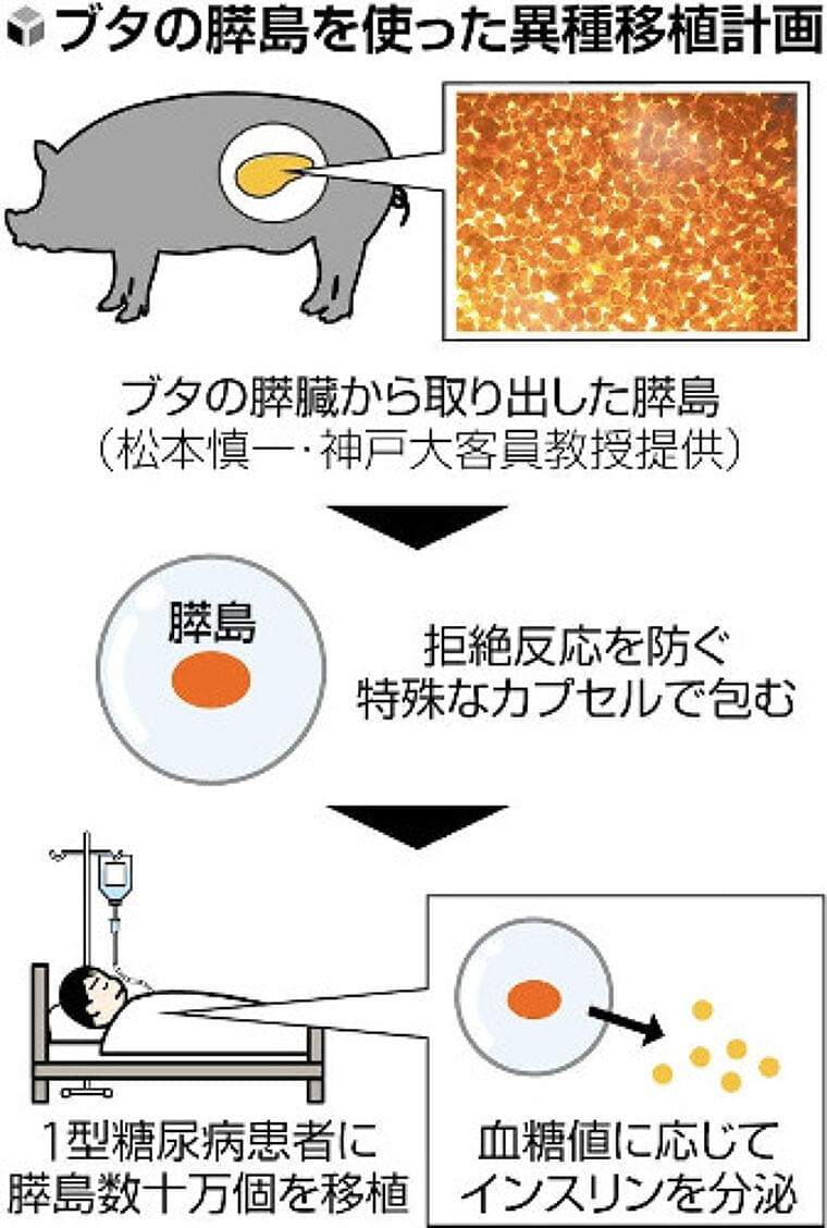糖尿病患者にブタの膵臓組織を移植、国際医療研など臨床研究…特殊カプセルに包み拒絶反応を防止 | ヨミドクター(読売新聞)