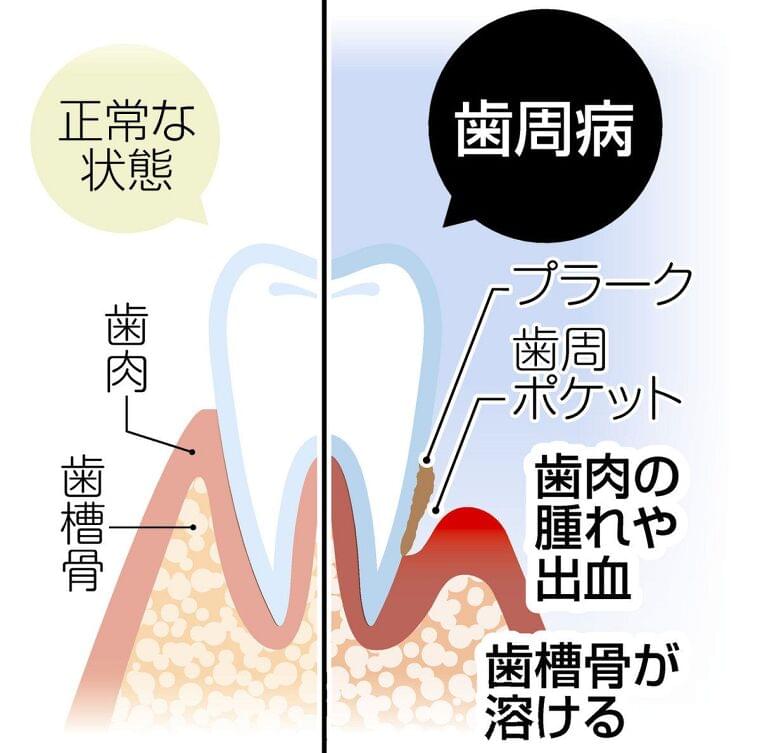 気付いた時には重症化…怖い歯周病 歯を失う原因第1位、糖尿病や心血管疾患にも影響:東京新聞 TOKYO Web