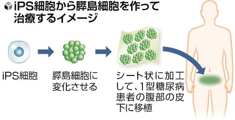 重症の糖尿病患者にiPS細胞による膵島細胞シート移植、京大病院が治験へ…来年1月に患者登録開始 | ヨミドクター(読売新聞)