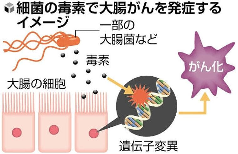大腸がん発症、腸内細菌が出す毒素「コリバクチン」が関係…細胞の遺伝子を傷つける性質 | ヨミドクター(読売新聞)